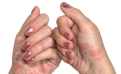 慢性湿疹偏方,缓解慢性湿疹不适